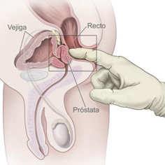 Cáncer de próstata