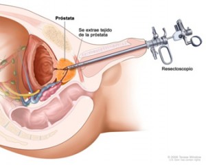 Hipertrofia benigna de próstata