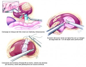 Nefrectomía laparoscópica