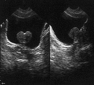 ecografia prostata adenoma