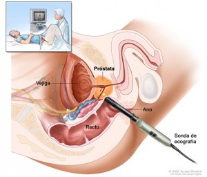 Ecografía transrectal