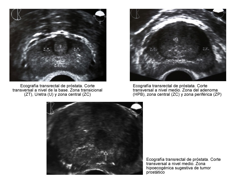 ecografía de próstata transrectal care suferă cel mai adesea de prostatită